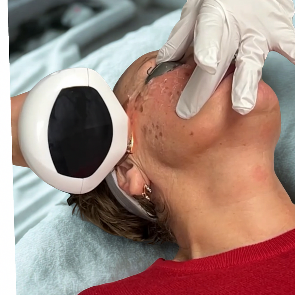 Woman receiving Lumecca IPL treatment in Vancouver