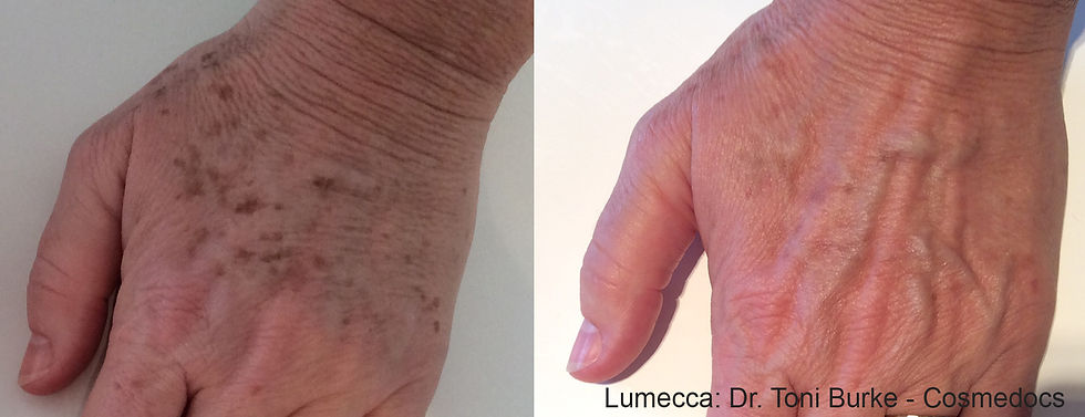 Thumbnail: Before and After Lumecca treatment on Woman's hands in Vancouver.