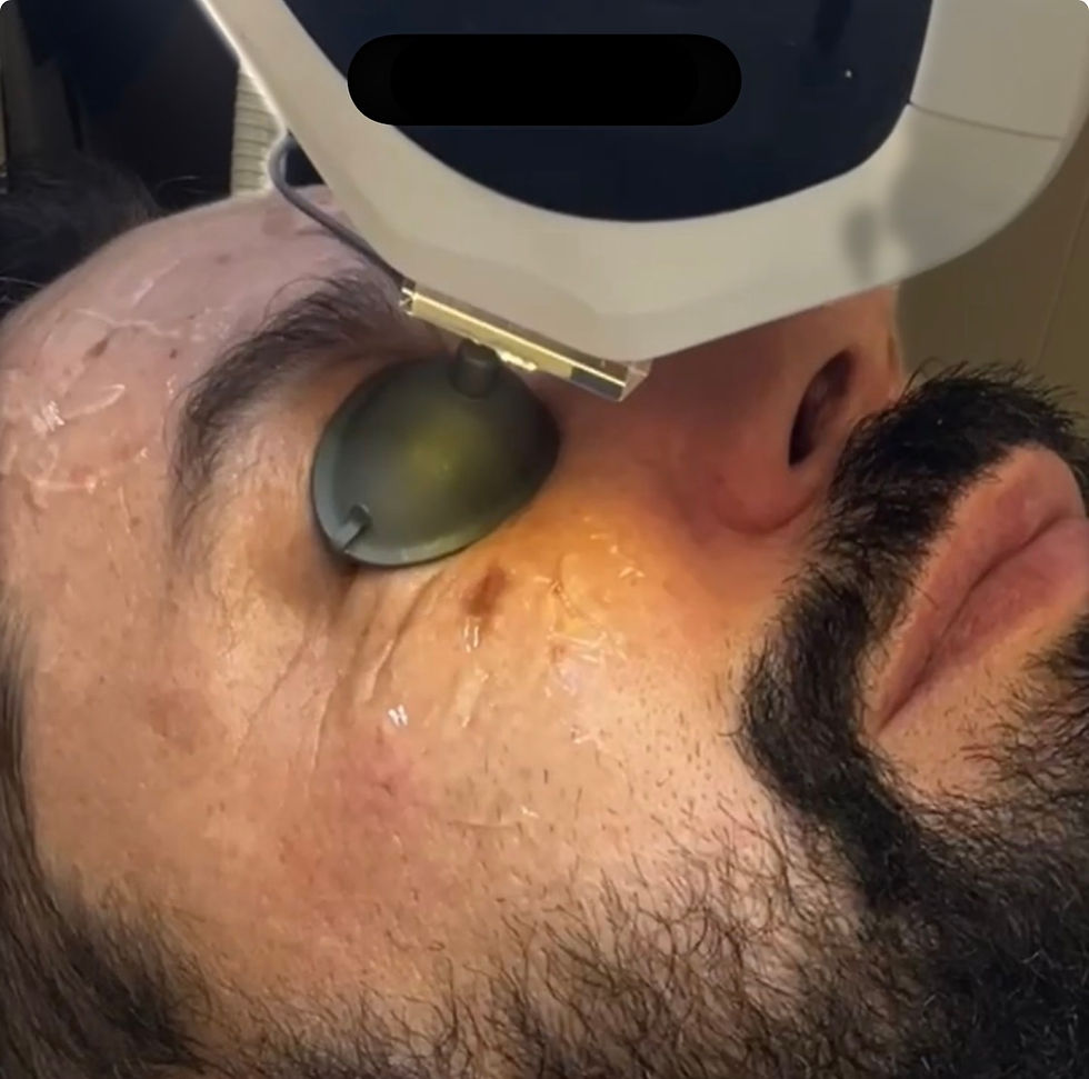 “Man is getting Lumecca IPL pigmentation removal treatment in Vancouver.