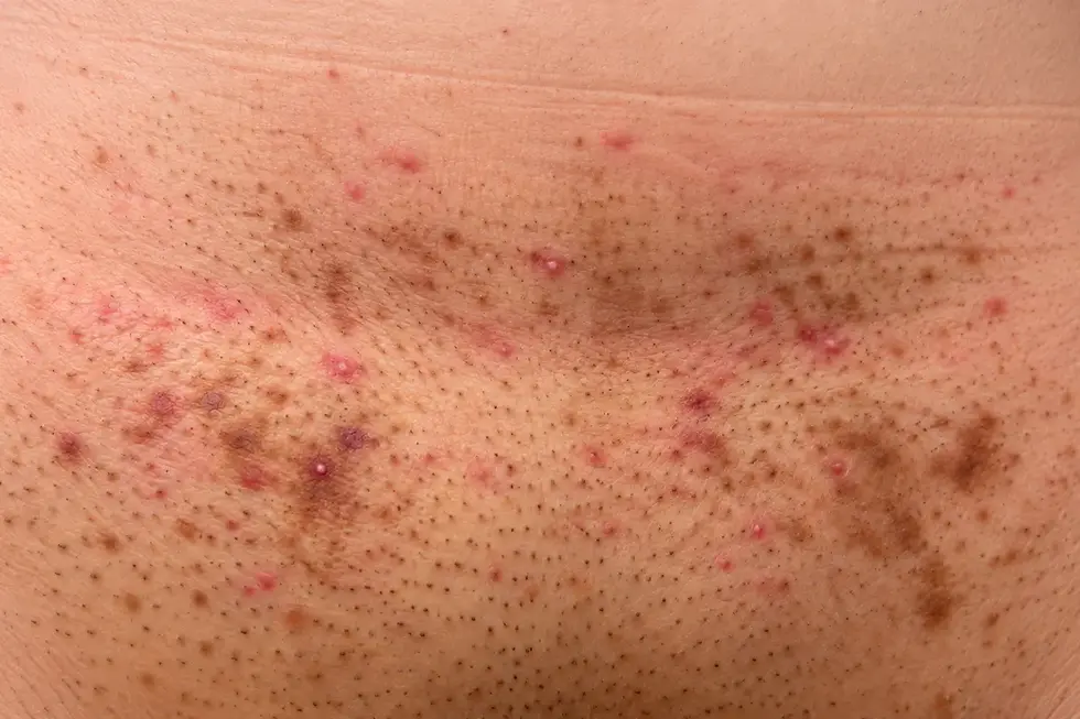 Shaving-related irritation, follicular bumps and uneven pigmentation in the male pubic area