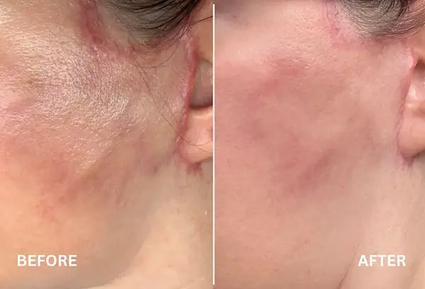 Post-operative surgery recovery in Vancouver: High-speed bruising and redness clearing using Lumecca IPL technology."
