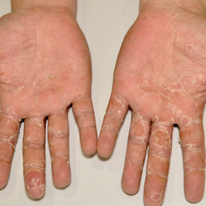 Eczema