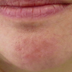 Rosacea/Acne Rosacea