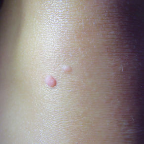 Viral Warts