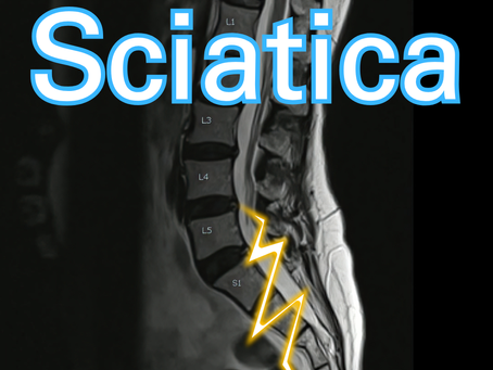Sciatic nerve pain caused by compression in the lower spine