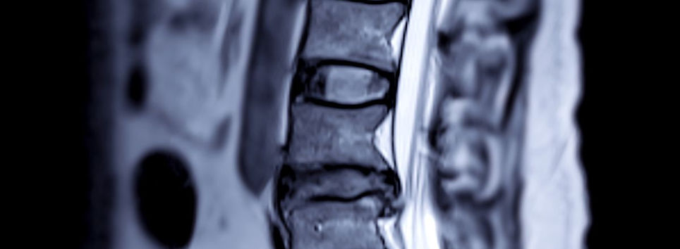 MRI of a herniated bulging disc