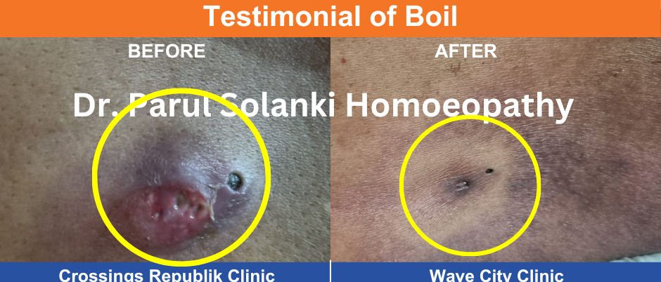 Boil on skin - red, swollen pus-filled bump treated with homeopathy