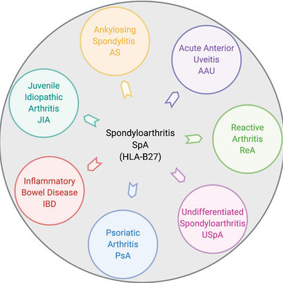 HLA-B27 Associated Uveitis