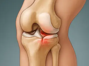 J'ai mal au genou interne, que faire ?