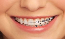 brackets-cerámica-ortodoncia-sant-cugat.jpeg