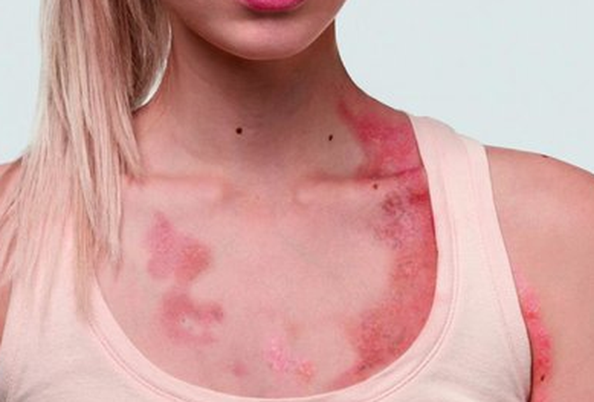Psoriasis