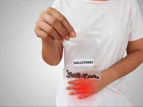 Gallstones: Why Do They Form; Separating Myth from Science