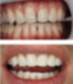Komposit Veneers