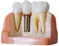 Root Canal_edited_edited.png