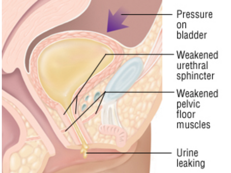 Pelvic Floor Incontinence: the differences, causes, and treatments