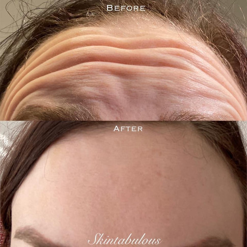 Botox