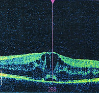 Optical Coherence Tomography (OCT)