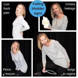 Bulging Isn't the Only Symptom of Prolapse