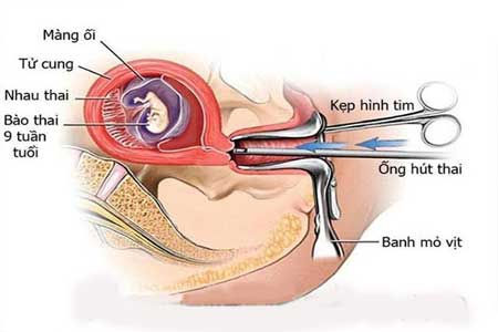 Nao hut thai 5 tuan tuoi theo quy trinh an toan