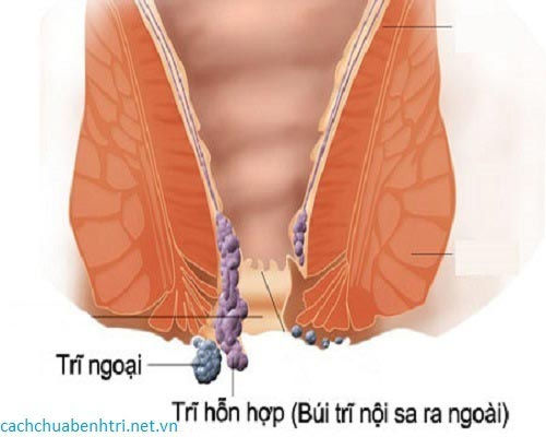Benh loi tri hon hop co dieu tri duoc khong?