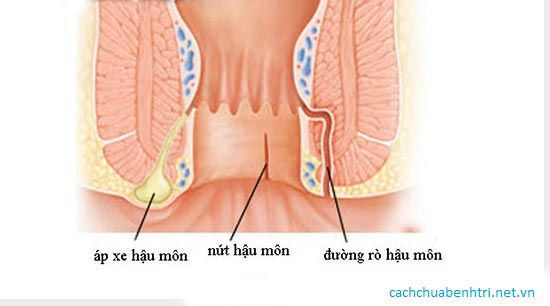 Bieu hien cua benh ro hau mon