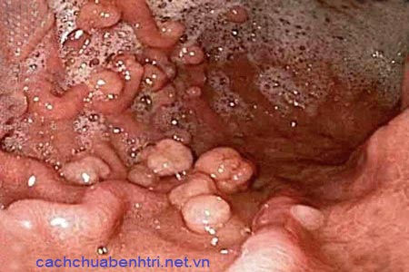 Cach dieu tri polyp truc trang phu hop