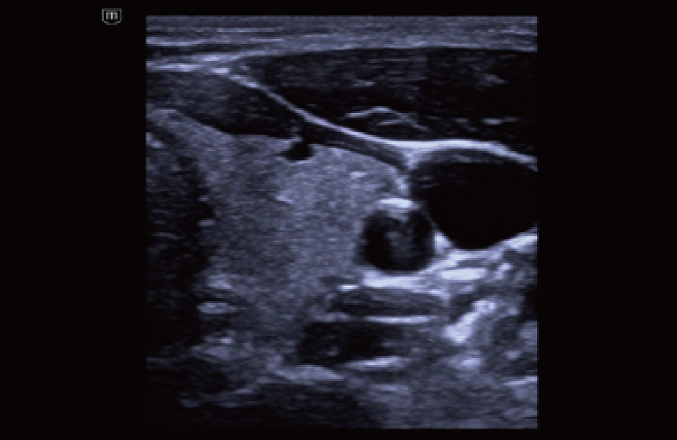 Thyroid with iTouch+