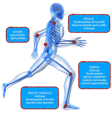 traitements par prp tendinite arthrose