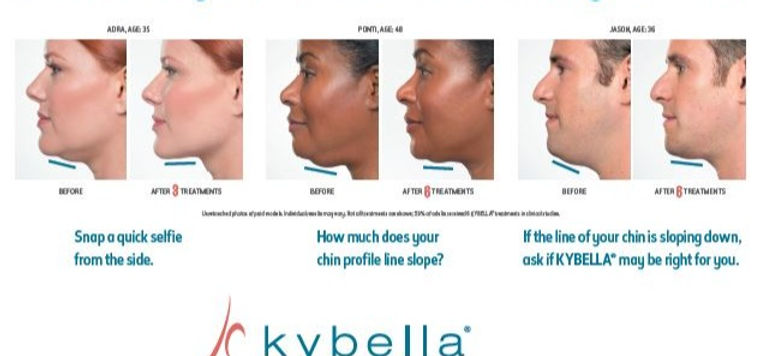 kybella
