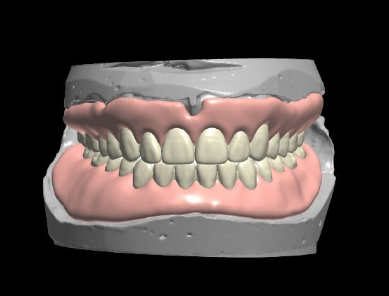 Digital Dentures
