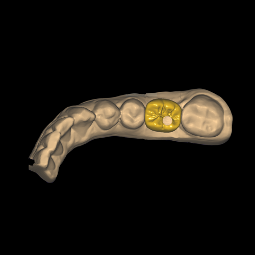 Screw Retained Crowns