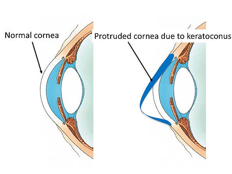 what is keratoconus.jpg