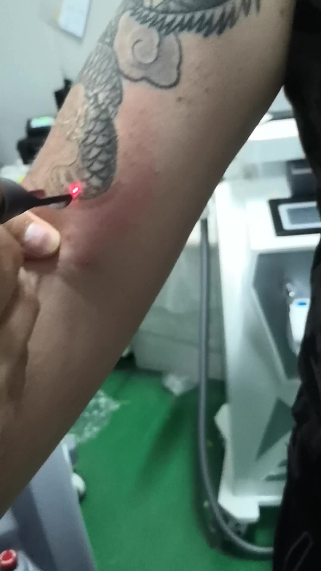 Professional pico second laser tattoo removal laser machine pico sure brown spo