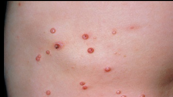 Molluscum Contagosium The Round Clinic