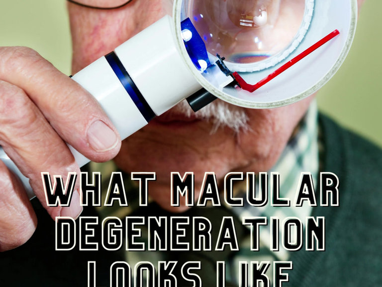 What Macular Degeneration Looks Like Kitsilano Optometrist