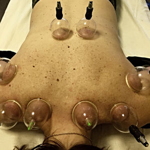 Cupping... How can it help you