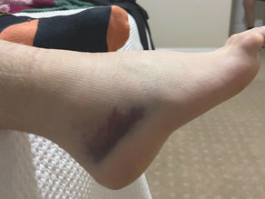 one sore and sprained ankle