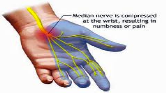 Carpal tunnel or not carpal tunnel - how do you measure up?