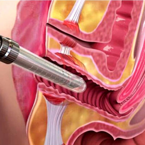 Laserbehandlung bei Harninkontinenz