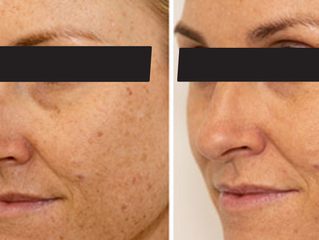 Why Does My Skin Feel Dry Even Though It's Summer?
