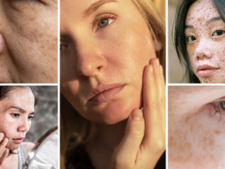 Melasma vs. Sun Spots vs. Post-Acne Marks: Understanding the Difference and Choosing the Right Treatment in Calgary
