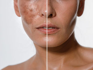 Why Fall & Winter Are the Perfect Seasons for Chemical Peels