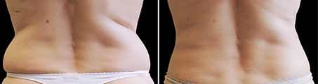 hifu_lovehandles_1_edited.jpg