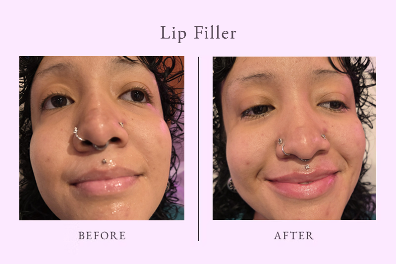 LipFiller_2.png