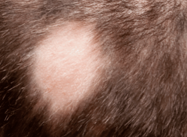Alopecia Aerata in Urdu language بالچر بالخورہ کا علاج