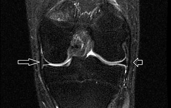 normal MRI Left Knee front, medial meniscus at long arrow, lateral meniscus at short arrow