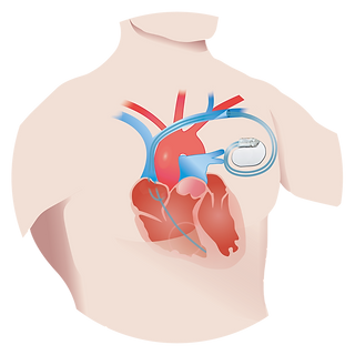 pacemaker.png