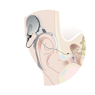 cochlear-01.png