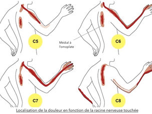 Névralgie cervico-brachiale : Traitement par un ostéopathe à Angers