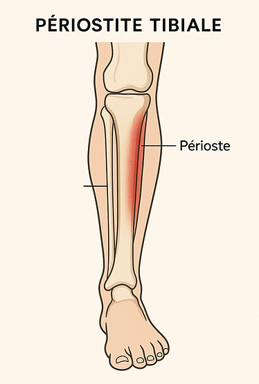 Schéma de la périostite tibiale expliquée par un ostéopathe à Angers